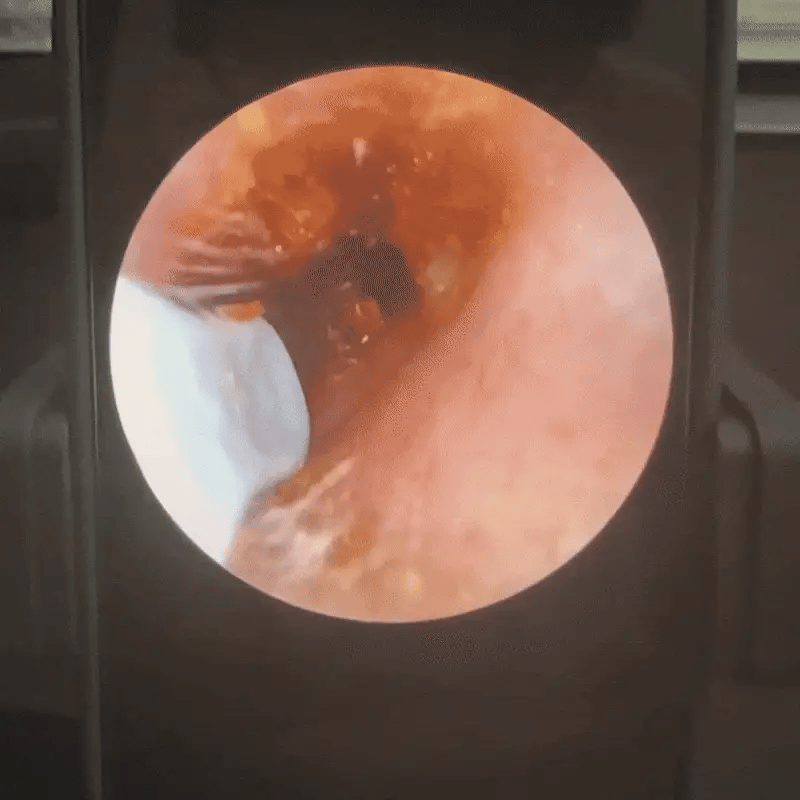 EarCleaner™ Earwax Removal Kit