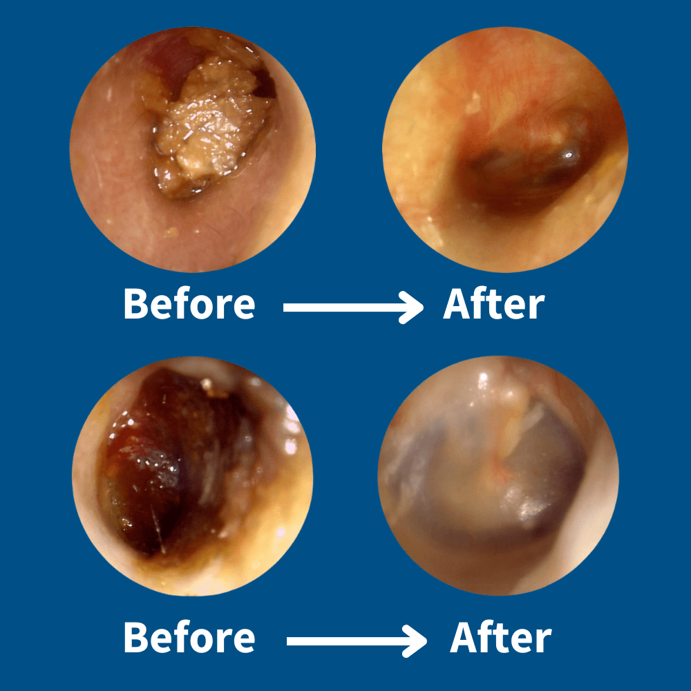 EarCleaner™ Earwax Removal Kit