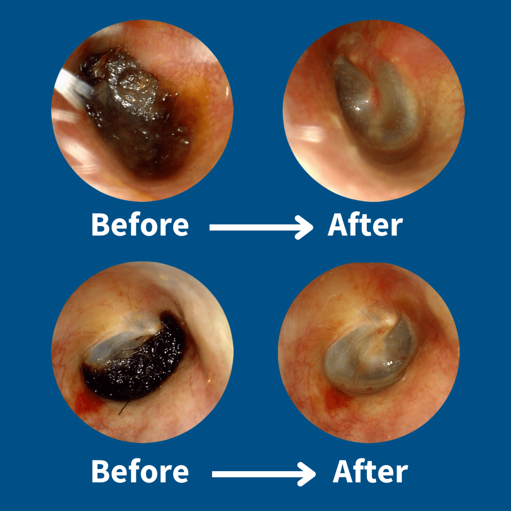 EarCleaner™ Earwax Removal Kit